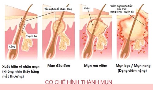 Các Cách Trị Mụn Đơn Giản Nhanh Chóng