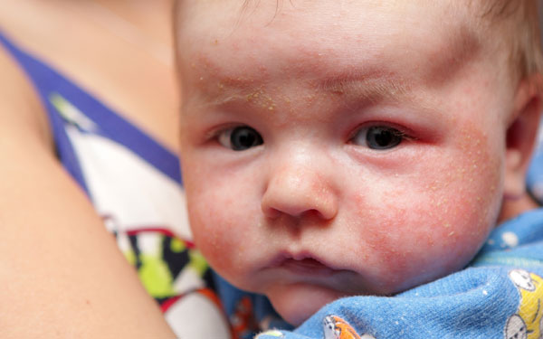 Cách Đề Phòng Bệnh Chàm Sữa Ở Trẻ Nhỏ