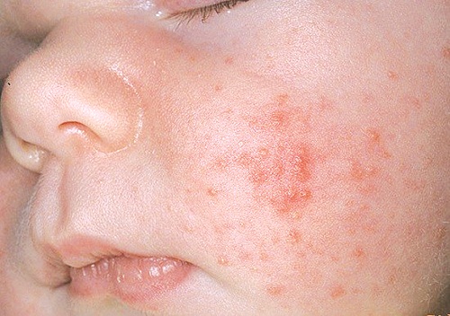 Viêm Da Khô Ở Trẻ - Bệnh Hay Gặp Mùa Hè