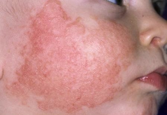 Bệnh Viêm Da Cơ Địa Ở Trẻ Sơ Sinh - Hãy Cẩn Trọng