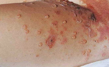 Nhận Biết, Điều Trị Bệnh Chốc Lở Ngoài Da Ở Trẻ Em