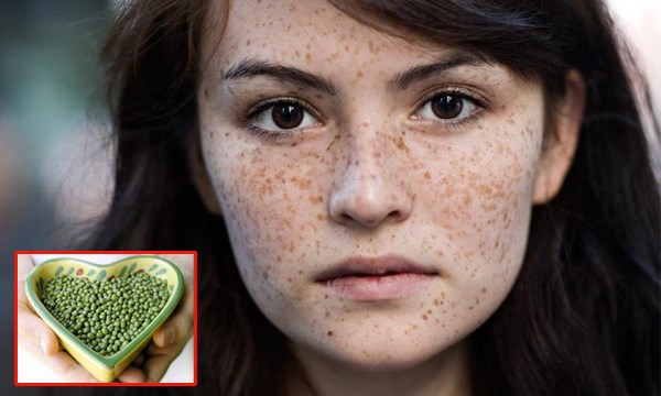 Trị nám, tàn nhang dễ dàng chỉ với đậu xanh