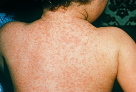 Phát Ban Ở Trẻ Em Vào Mùa Hè