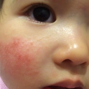 TỔNG QUAN VỀ BỆNH VIÊM DA CƠ ĐỊA