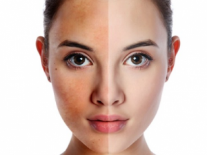 Cách Chữa Trị Tàn Nhang Hiệu Quả Tại Nhà