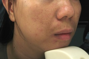 TRỊ SẸO RỖ Ư? TÔI ĐÃ THÀNH CÔNG!