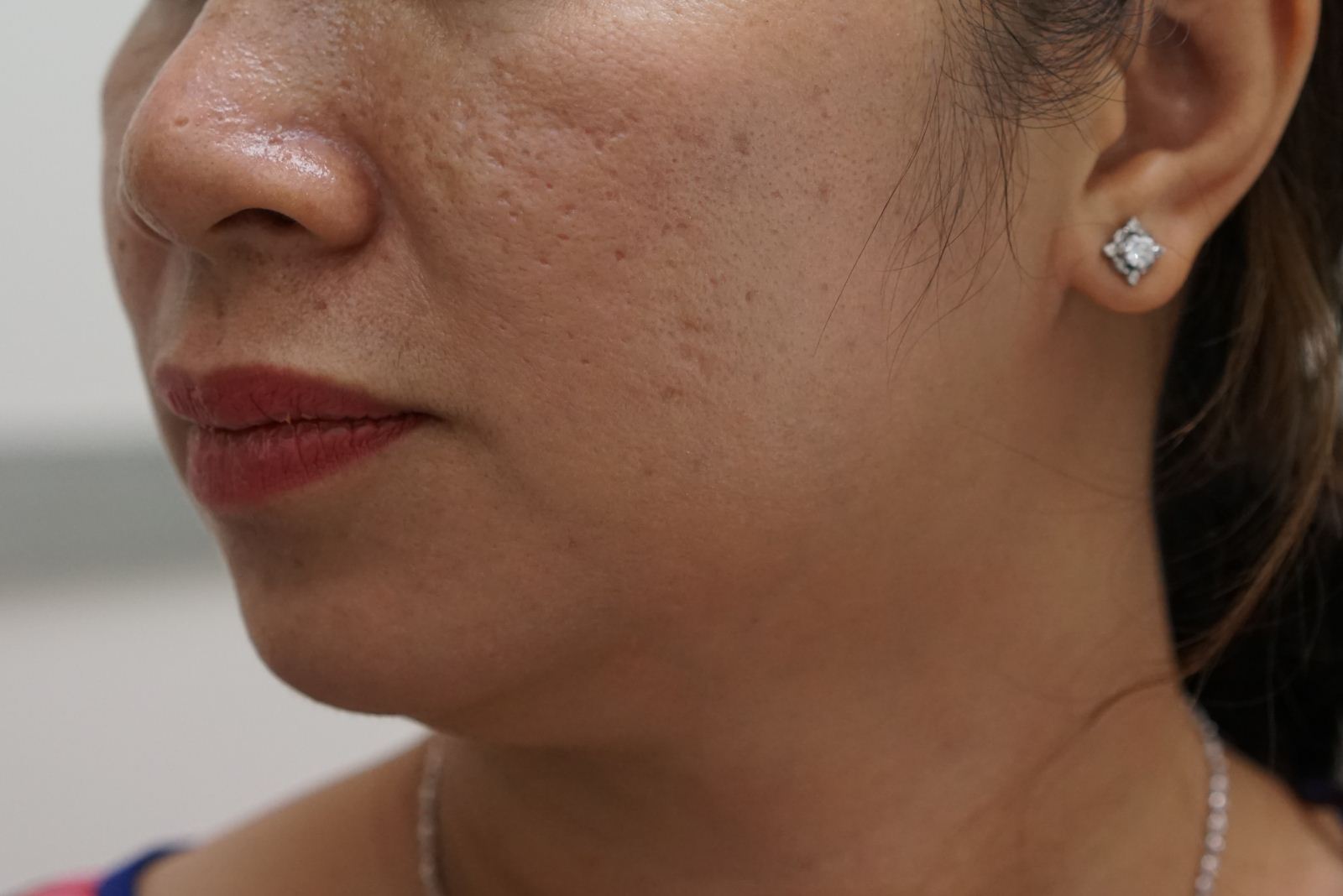 ĐỪNG ĐỂ SẸO RỖ TẤN CÔNG LÀN DA BẠN