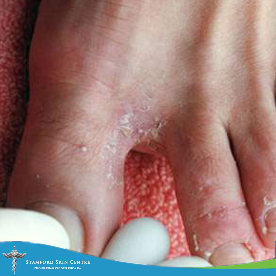 CÁC BỆNH DA LIỄU THƯỜNG GẶP TRONG MÙA HÈ