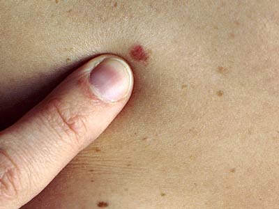 UNG THƯ DA – PHÒNG BỆNH HƠN CHỮA BỆNH