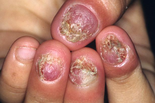 ĐIỀU TRỊ NẤM MÓNG VỚI PHƯƠNG PHÁP HIỆN ĐẠI