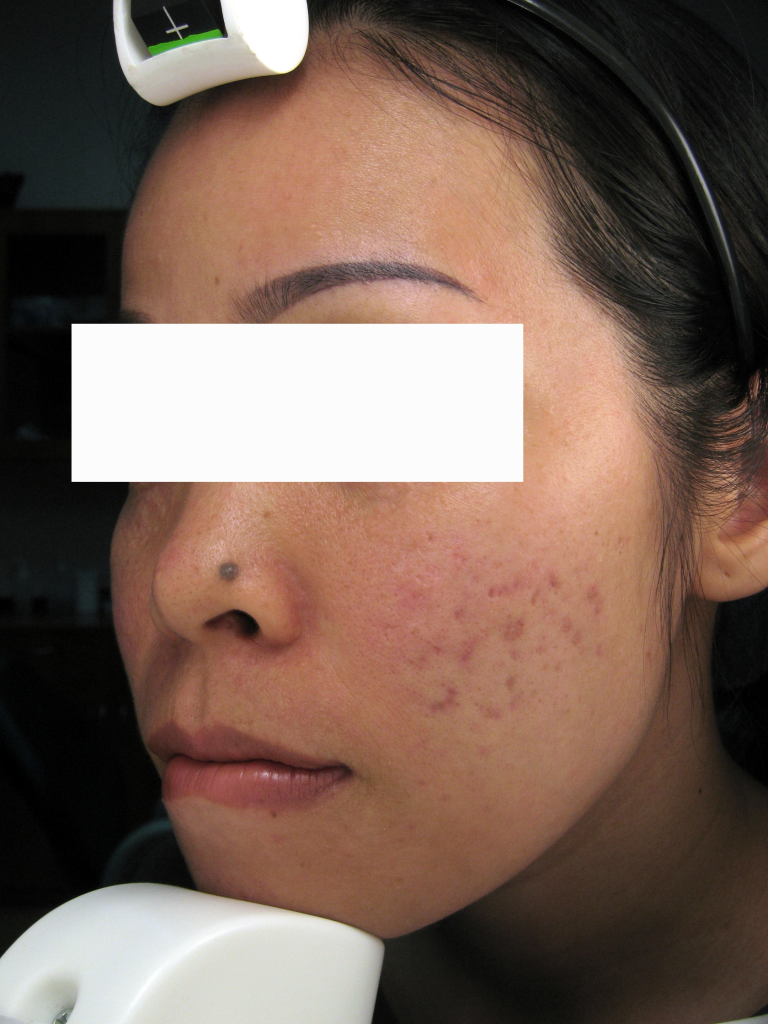 TẠM BIỆT SẸO RỖ VỚI CÔNG NGHỆ ULTRA – MICRO FRACTIONAL CO2 LASER