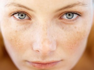 TRỊ NÁM – HÃY ĐIỀU TRỊ MỘT LẦN VÀ DỨT ĐIỂM