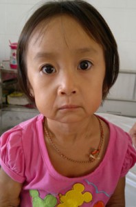 TÌM BỆNH CHO BÉ BỊ LÃO HÓA DA SỚM