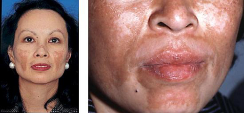 NÁM VÀ CÁCH ĐIỀU TRỊ NÁM