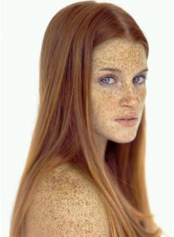 TÀN NHANG VÀ CÁCH ĐIỀU TRỊ TÀN NHANG