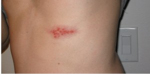 CÁCH PHÒNG BỆNH GIỜI LEO