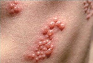 CÁCH TRỊ BỆNH GIỜI LEO