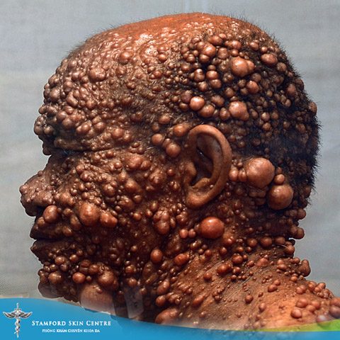 BỆNH DA LIỄU LẠ DA BỊ PHỒNG RỘP – LAUW TJOAN ENG