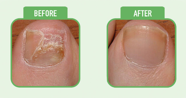 PHƯƠNG PHÁP ĐIỀU TRỊ MỚI BẰNG LASER CHO BỆNH NẤM MÓNG (BROCHURE)