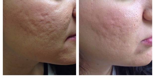 INFINI: XÓA SỔ SẸO VÀ NẾP NHĂN TRONG TÍCH TẮC