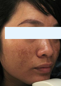 CÁCH PHÒNG TRÁNH NÁM DA MẶT VÀ ĐỒI MỒI