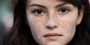 NÁM TÀN NHANG DO UỐNG THUỐC CHỮA THẾ NÀO?