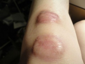 CÁCH CHỮA SẸO LỒI THÀNH CÔNG CỦA TÔI