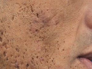 BẠN ĐANG CHỊU ĐỰNG NHỮNG LOẠI SẸO RỖ NÀO?