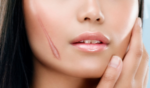 SẸO LỒI: KHÓ ĐIỀU TRỊ, DỄ TÁI PHÁT