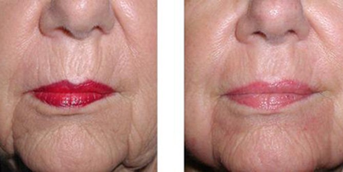 NGUYÊN NHÂN LÃO HÓA DA - NHĂN DA