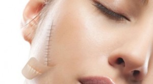 SẸO PHẪU THUẬT