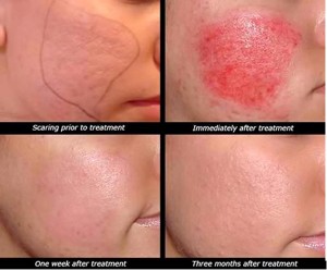 CÀ MẶT CHỮA SẸO RỖ – HIỂM HOẠ KHÔN LƯỜNG!