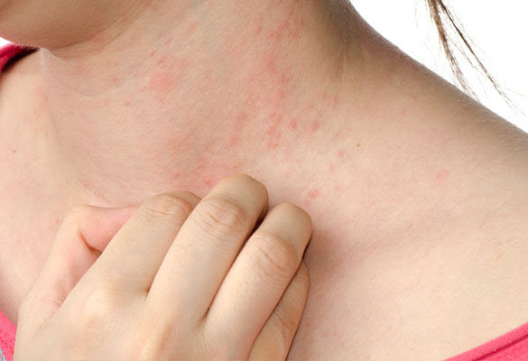 VIÊM DA BÀN TAY DO CHẤT KÍCH THÍCH (ECZEMA)