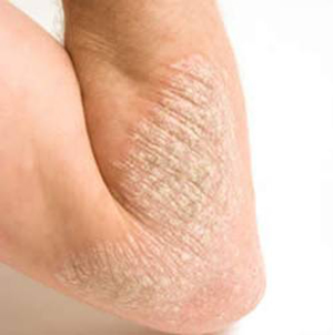 DỊ ỨNG DA ECZEMA (VIÊM DA)