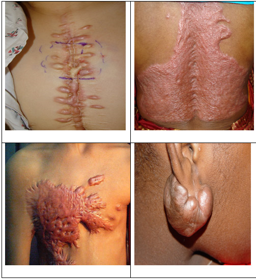 Những điều cần biết về Sẹo Lồi (Keloid - Chéloïde)