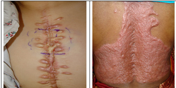 Những điều cần biết về Sẹo Lồi (Keloid - Chéloïde)