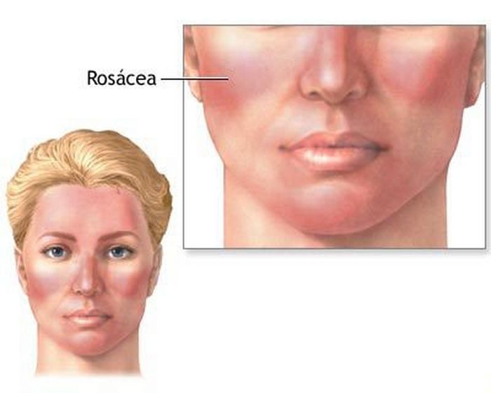 DA VÀ BỆNH ROSACEA