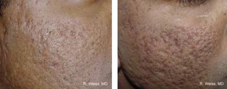 SẸO MỤN VÀ CÁCH ĐIỀU TRỊ SẸO MỤN