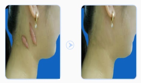 Phương pháp giảm ngứa do sẹo lồi