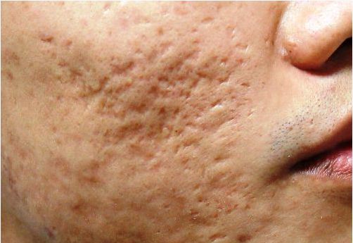 CÁCH LÀM MỜ SẸO RỖ DO MỤN ĐỂ LẠI