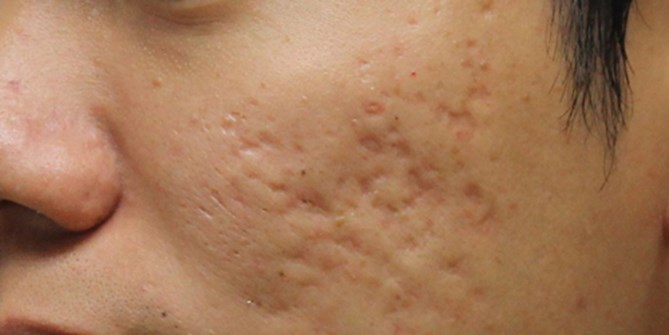 Mẹo điều trị sẹo rỗ lâu năm trên mặt an toàn tuyệt đối