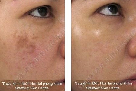 ĐIỀU TRỊ NÁM DA TẬN GỐC