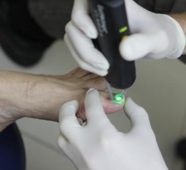 Laser Trị Nấm Móng