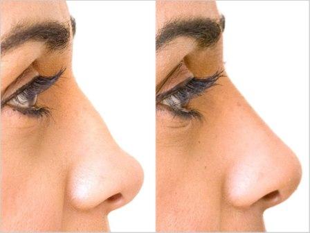 Nâng Mũi Đẹp Không Cần Phẫu Thuật Restylane