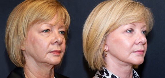 Căng Da Không Phẫu Thuật