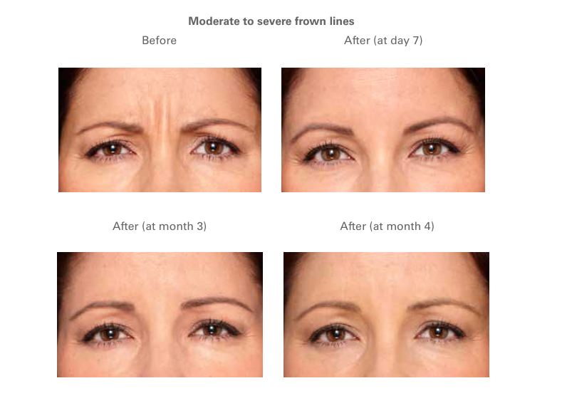 Thực tế Botox có giúp trẻ hóa làn da?