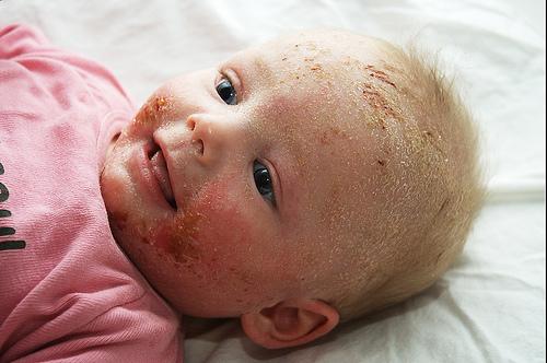 ĐIỀU TRỊ VIÊM DA DỊ ỨNG