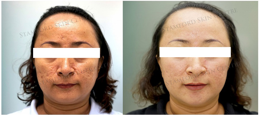 ĐIỀU TRỊ SẸO RỖ HIỆU QUẢ