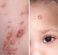 U Mềm Truyền Nhiễm (U Mềm Lây)