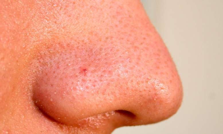 Điều Trị Mụn Cám